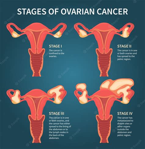 Premium Vector Ovarian Cancer Stages Mentioning Ovaries