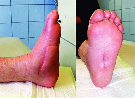 Clinical Appearance After Surgical Reconstruction Completely Healed