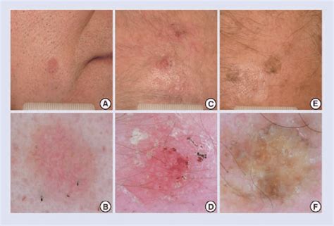 Clinical And Dermoscopic Grading Of Actinic Keratosis A And B Grade 1