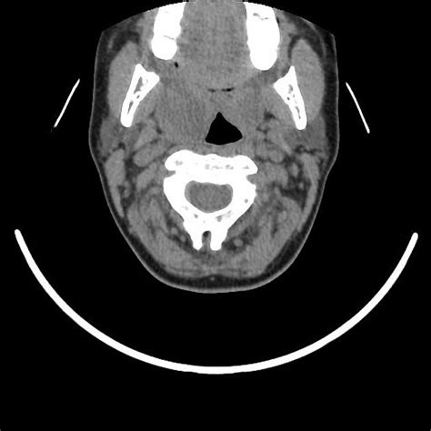 Peritonsillar Abscess X Ray