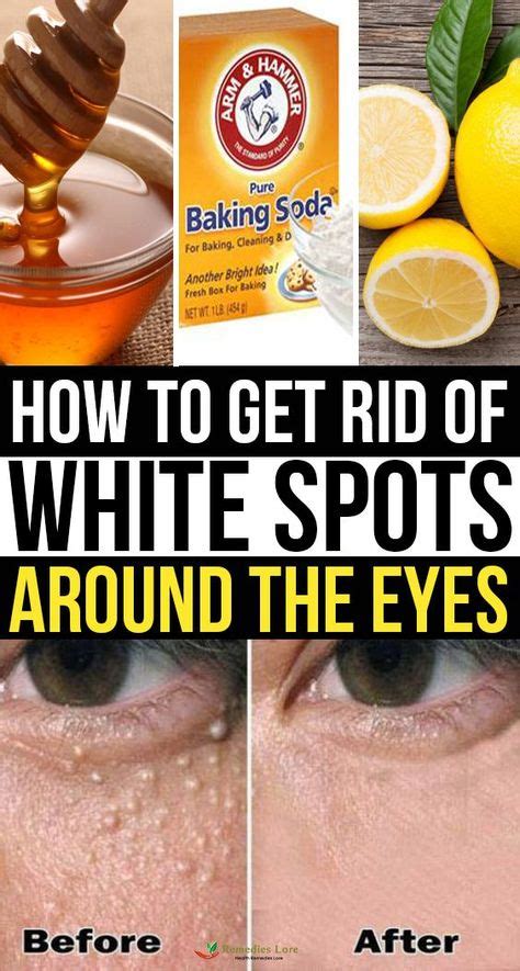How To Get Rid Of White Spots Around The Eyes Skin Spots Health And