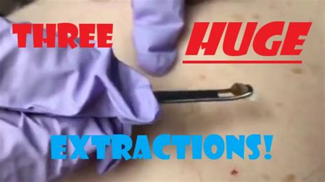 Three Huge Blackhead Extractions Stubborn Cysts On The Back Youtube