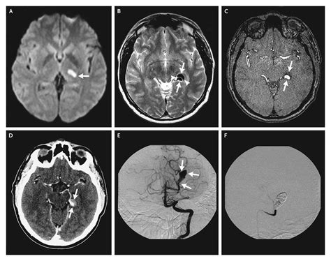Cerebral Aneurysm Angiogram