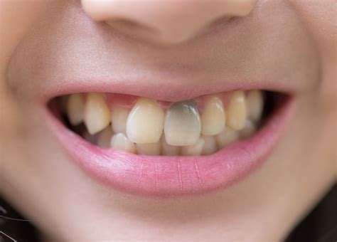 7 Signs Of Tooth Decay La Mesa Ca Cardinal Dental