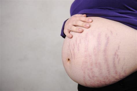 Stretch Marks During Pregnancy Why Do People Suffer Who Don T