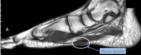 It must be placed in the center of the magnet, to obtain homogeneous fat. Plantar Fibroma and Fibromatosis | Mr Malik at LFAC