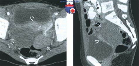 Диета при лимфоме не ходжкина КТ, МРТ, УЗИ при лимфоме яичника КТ, МРТ, УЗИ при лимфоме яичника Диета при лимфоме не ходжкина