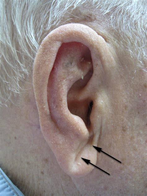 Diagonal Ear Lobe Crease And Atherosclerosis A Review Of The Medical