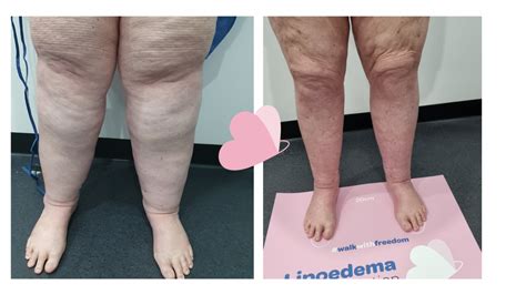 Lipoedema Surgery Case 16 Lipoedema Surgical Solution