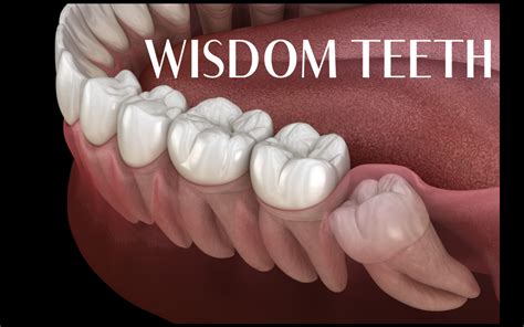 Wisdom Teeth All Out Wisdom Teeth