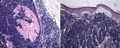 Some people are at higher risk than others for developing merkel cell carcinoma. Radioactive seed implantation in treatment of an eyelid ...