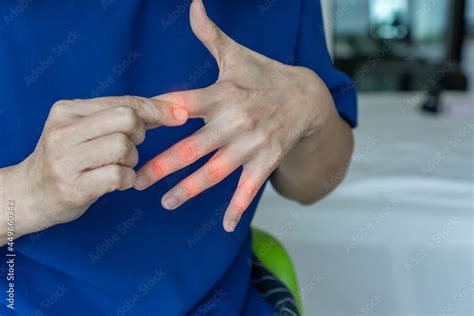 Foto De Overuse Hand Problems Womans Hand With Red Spot O Fingers As