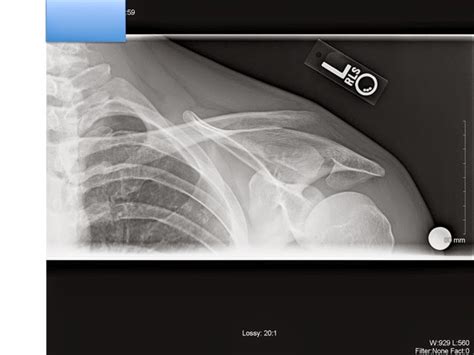 Shoulder And Elbow Surgery Clavicle Fracture Broken Collarbone