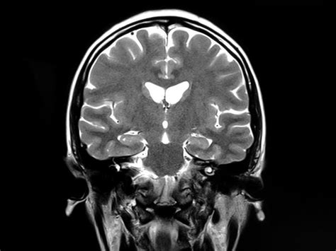 Mri Shows Brain Microstructural Changes After M