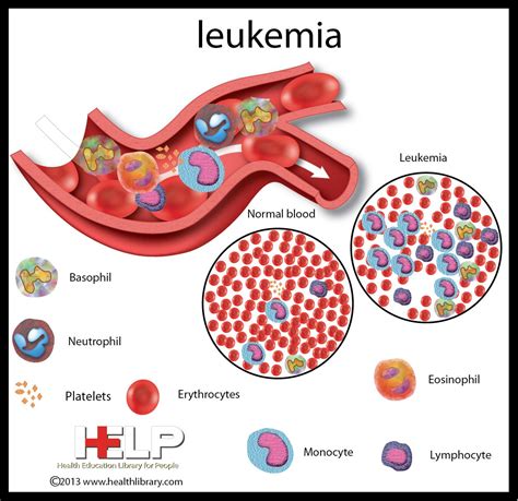 Leukemia Biology And Science Pinterest