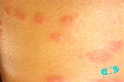Viral Rashes In Children Pictures Photos