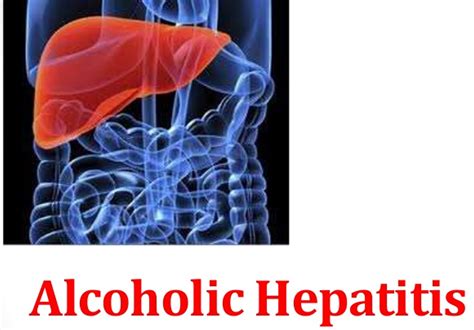 Acute Alcoholic Hepatitis Symptoms Prognosis Treatment And Recovery