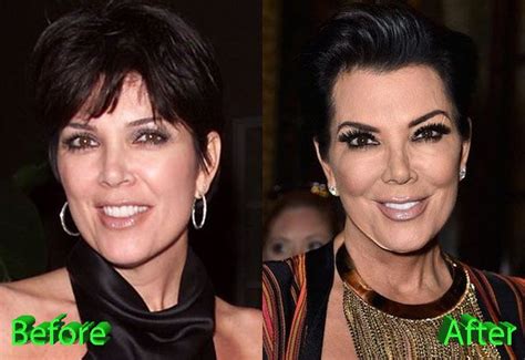 Kris Jenner Before And After Facelift Procedure Kris Jenner Plastic