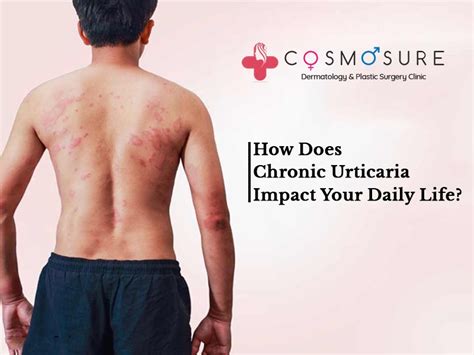 How Does Chronic Urticaria Impact Your Daily Life Cosmosure Clinic
