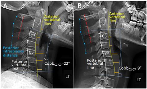 Comparison Of Cervical Alignment On Sagittal Radiographs In Neutral