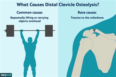 Causes And Treatment Of Distal Clavicle Osteolysis