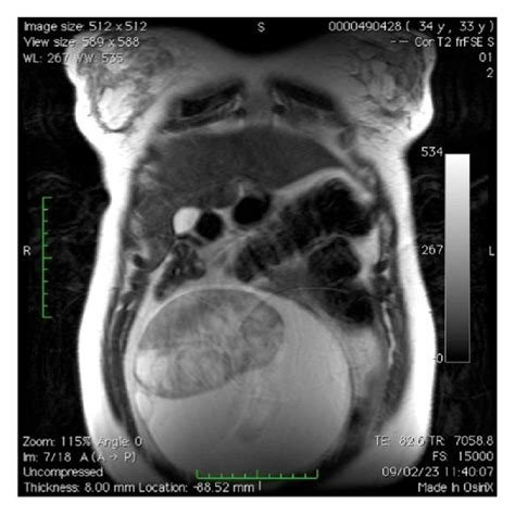 Mri Showing The Solid Component Of The Adnexal Mass Download