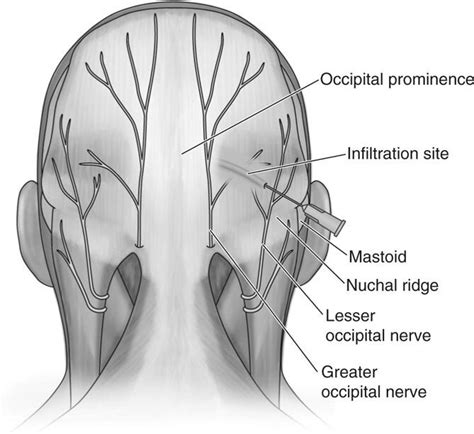 Occipital Nerve Block Injection