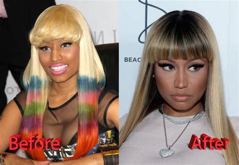 nicki minaj plastic surgery before and after2 plastic surgery mistakes