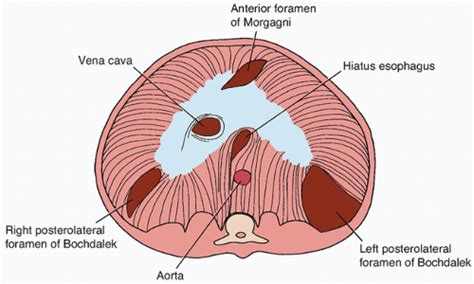 Congenital Diaphragmatic Hernia Anesthesia Key
