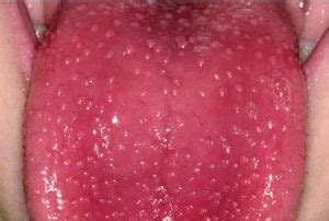 Le complicanze a partire dai problemi alle ossa in poi sono molto rare). lingua a fragola