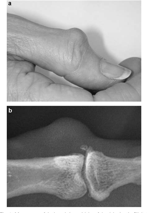 Figure 1 From Surgical Treatment Of Mucous Cysts By Subcutaneous