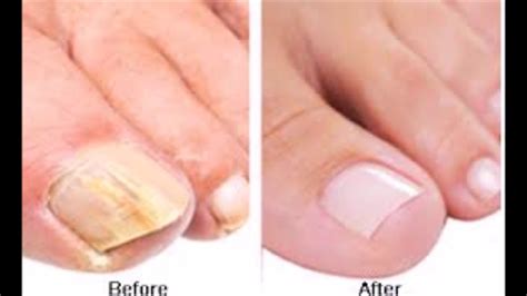 How To Get Rid Of Toenail Fungus Fast And Naturally Toe Nail Fungus Cure Youtube