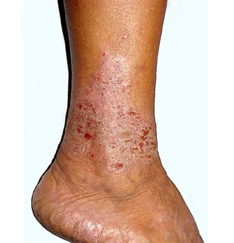 Causes Of Venous Stasis Dermatitis