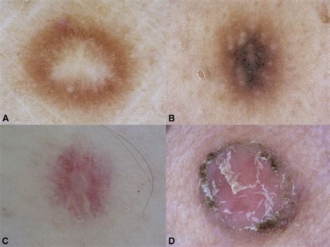 The Dermoscopic Variability Of Dermatofibromas Journal Of The American Academy Of Dermatology