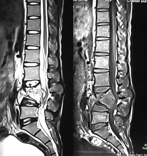 Radiodiagnosis Imaging Is Amazing Interesting Cases Pottts Spine
