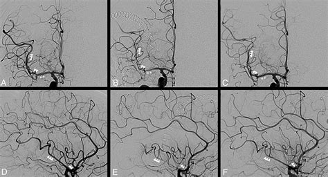 Distal Balloon Angioplasty Of Cerebral Vasospasm Decreases The Risk Of