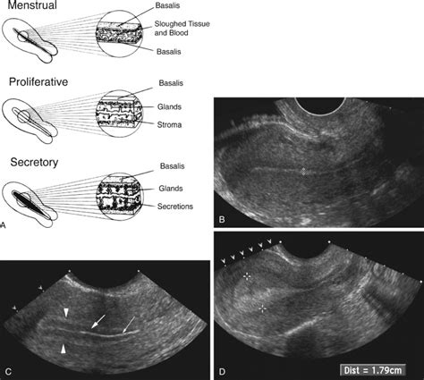 anteverted uterus ultrasound