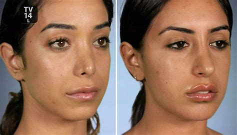Nose job check tiktok compilation. Sisters branded 'psycho' after matching nose jobs ...