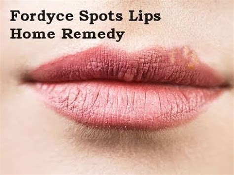 Fordyce Spots On Lips Pics Lipstutorial Org