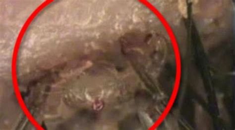 Cara Menghilangkan Kutu Rambut Kelamin