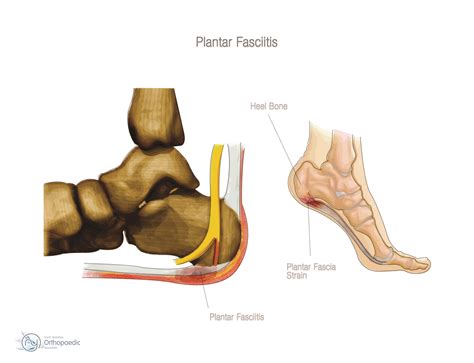 Tired Achy Painful Feet Dont Let Plantar Fasciitis Stop You In