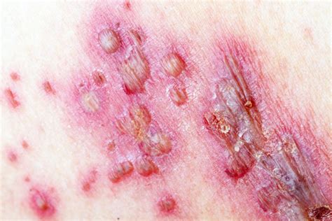 Herpes Zoster Shingles Natures Rite