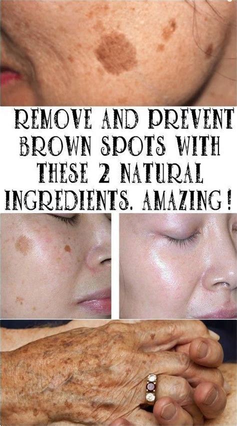 Take Care In 2020 Brown Spots On Skin Brown Spots On Face Spots On Face