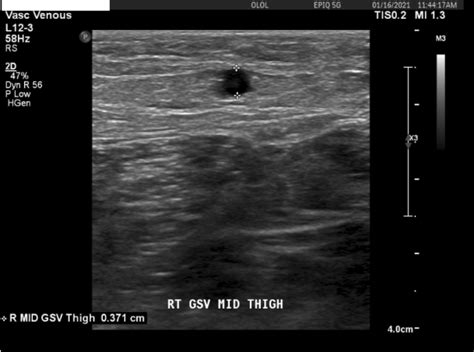Vein Mapping Cvt Surgical And Vein Therapy Center Bypass Graft