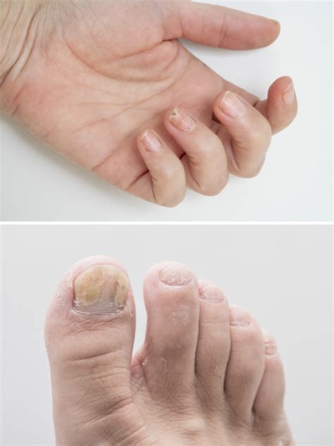 Nail Repair Liquid Hand And Foot Onychomycosis Care Repair