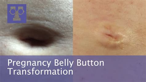 Does Your Belly Button Change Color During Pregnancy Siambookcenter