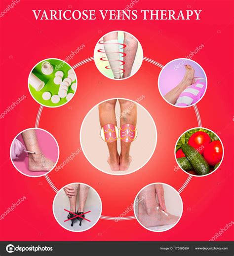 Treatment Of Varicose Veins — Stock Photo © Marina113 170560904