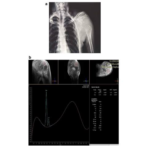 A 42 Year Old Female Patient With Swelling In Left Shoulder Joint A Ap