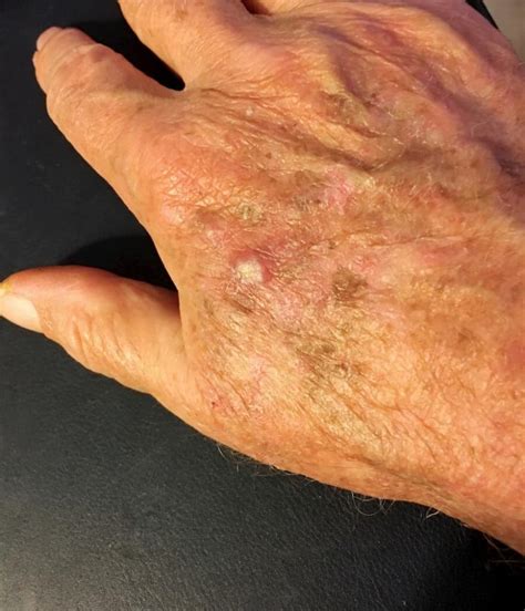 Squamous Cell Carcinoma Squamous Cell Skin Cancer Jacksonville