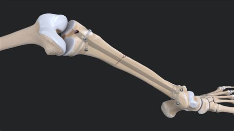 Arthrex Tibial Nail System—standard Surgical Technique